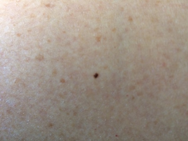 The suspicious dark spot that needs to be watched.